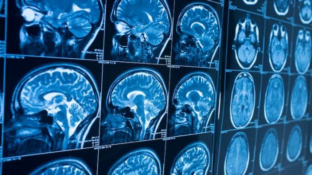 MRI scan of brain