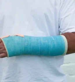 Man with broken arm in blue plaster cast