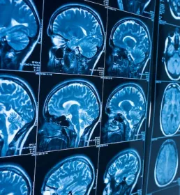 MRI scan of brain