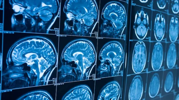 MRI scan of brain